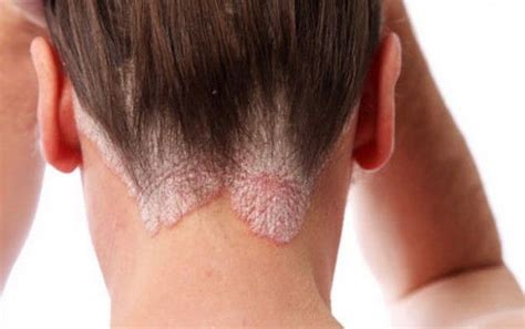 5 Maneras De Eliminar La Psoriasis Para Siempre Con Remedios Caseros