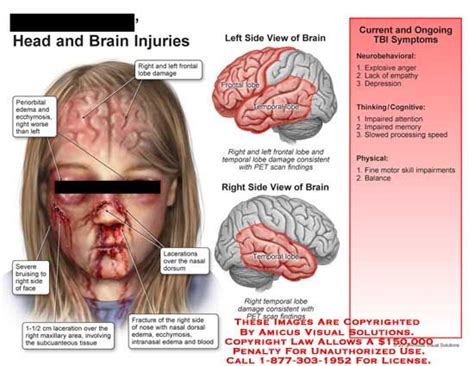 Frontal Lobe Brain Injury Brain Injury Brain Injury Awareness