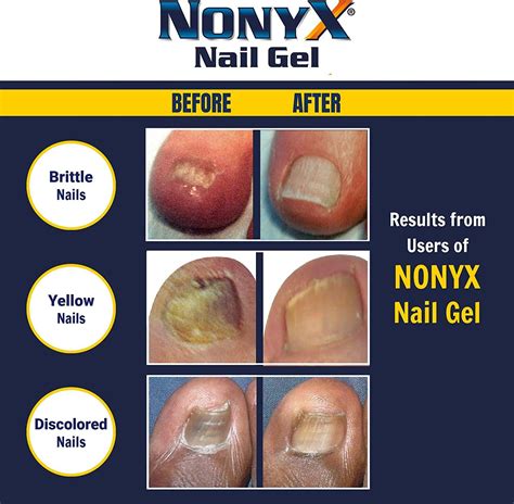 Nonyx Nail Gel A Toenail Fungus Treatment That Clears Out Fungus By