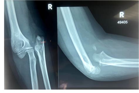 Figure 1 From Pediatric Anterior Elbow Dislocation Due To A Rare