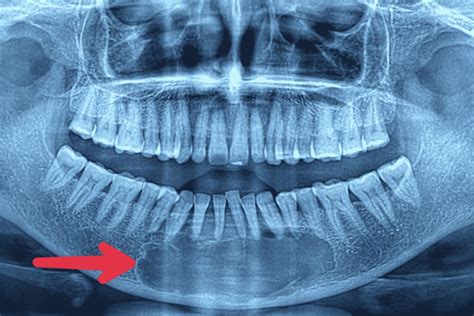 Cureus Intraosseous Mucoepidermoid Carcinoma Of The Anterior Mandible