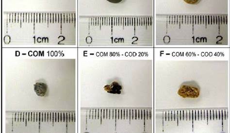 Vibroacoustography Imaging of Kidney Stones In Vitro | Semantic Scholar