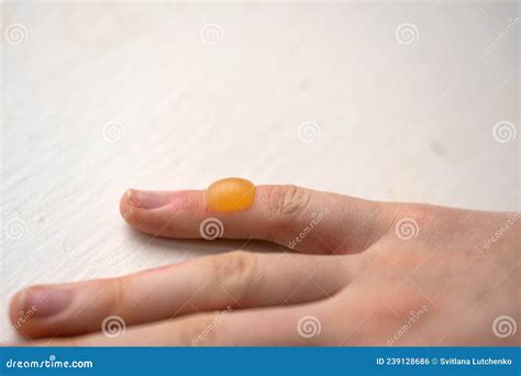 A Blister From A Burn On A Girland X27s Hand Stock Photo Image Of