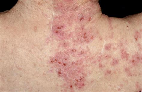 Shingles Lesions Photograph By Dr P Marazziscience Photo Library