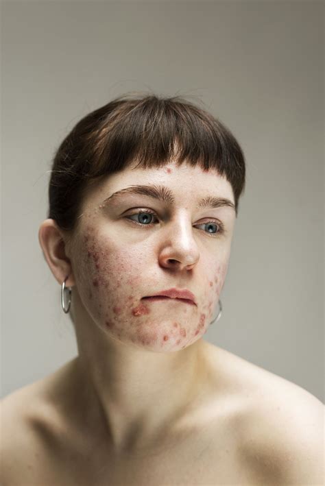 Photographs Of Bare Faced Women With Common Skin Conditions Celebrate The Beauty Of Imperfection