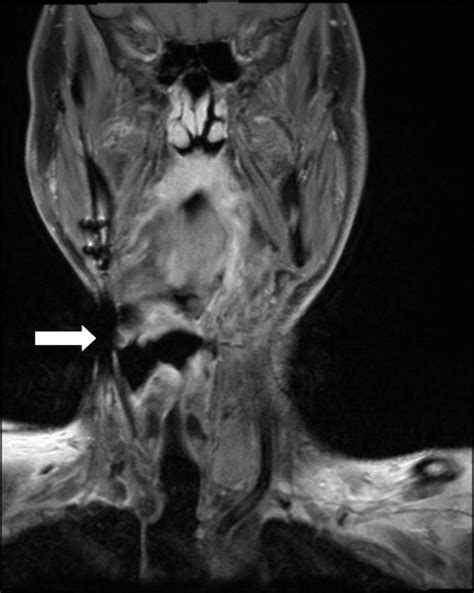 Surgical Management Of Metastases That Involve The Carotid Artery In