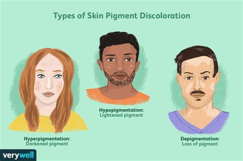 Skin Pigmentation Genetics Discoloration And Treatment