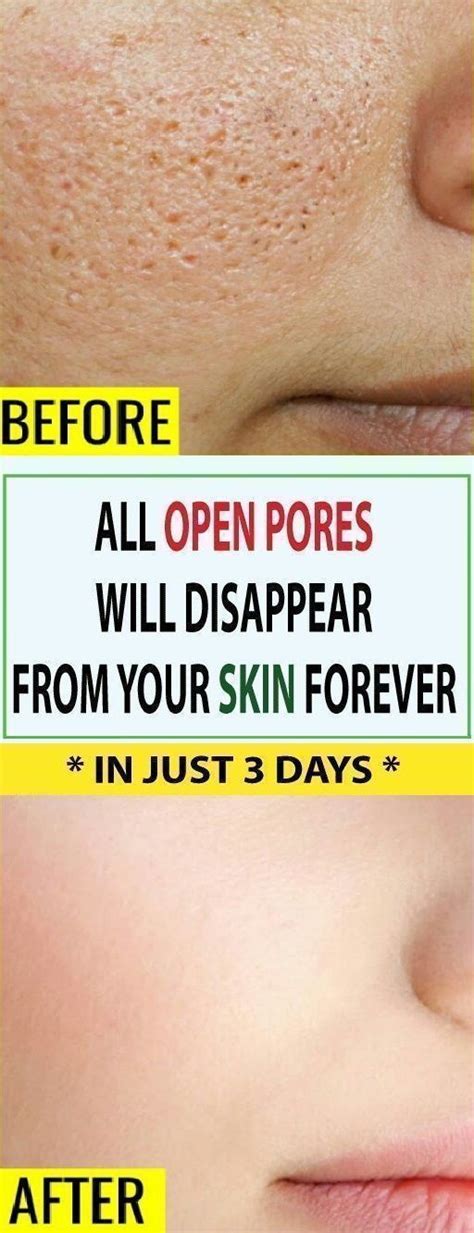 How To Close Open Pores On Face And Skin Permanently Open Pores On
