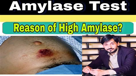 Amylase determinations are performed in the diagnosis and treatment of diseases of the pancreas and the investigation of pancreatic function. Amylase Test - YouTube