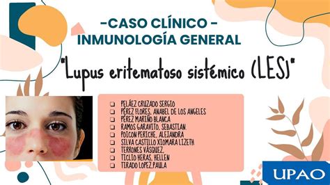 Lupus Eritematoso Sistémico Apuntes De Medicina Inmunología Udocz