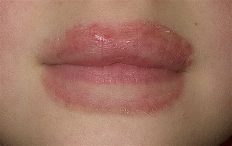 Eczema On Lips Pictures Causes Contagious Treatment Home Remedies