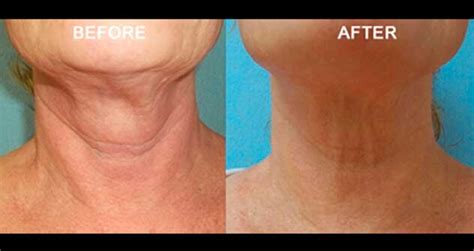Non Surgical Necklift Nyc Fractora Radiofrequency For Necklift