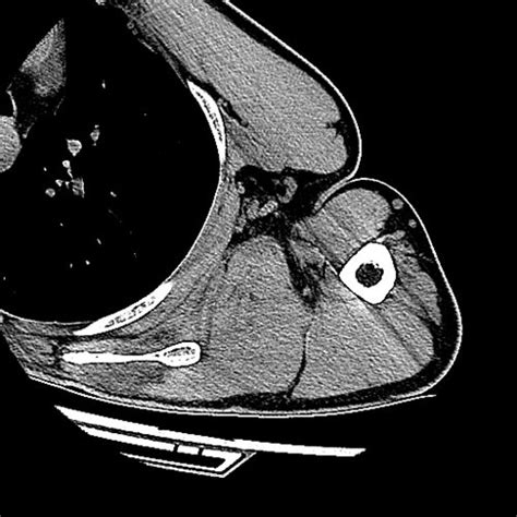Ct Scapula And Humerus Upper Extremity Cts