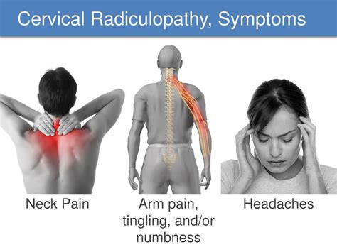Cervical Radiculopathy Pain Relief Porn Sex Picture