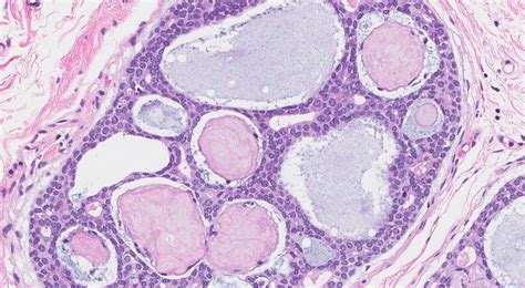 Adenoid Cystic Carcinoma Of The Breast Atlas Of Pathology