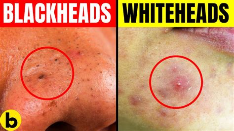 Blackheads Vs Whiteheads Whats The Difference And How To Get Rid Of
