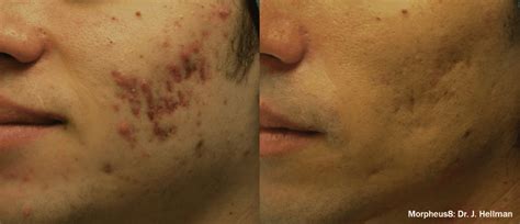 Acne Scars Rejuvenate Skin And Wellness Center Medical Spa Aesthetics