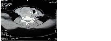 Surgical Approaches To Retrosternal Goiter When Sternotomy Is