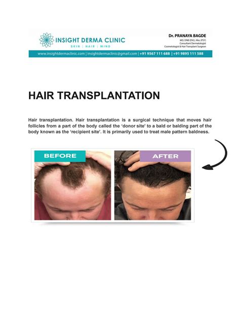 Hair Transplant In Kochi By Insight Derma Clinic Issuu