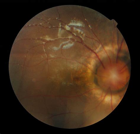 Morning Glory Disc Anomaly In Association With Ipsilateral Optic Nerve Glioma Congenital
