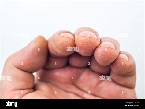 Dyshidrosis Banque De Photographies Et Dimages à Haute Résolution Alamy