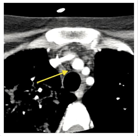 Computed Tomography Scan Of The Neck The Arrow Indicates A Soft Tissue