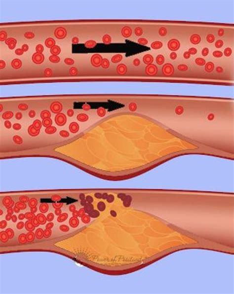 Here Are Some Warning Signs And Symptoms Of Blocked Arteries And