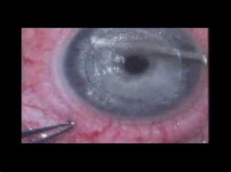 Lasik With Intralase Youtube