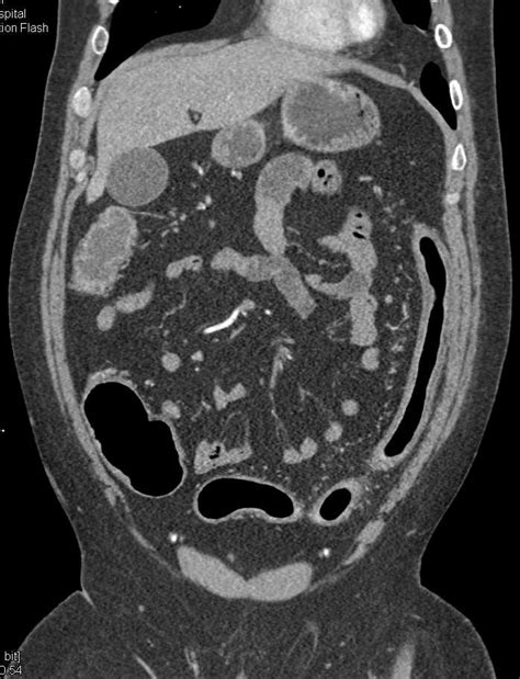 Ulcerative Colitis With Prominent Vascular Vasa Recta Colon Case
