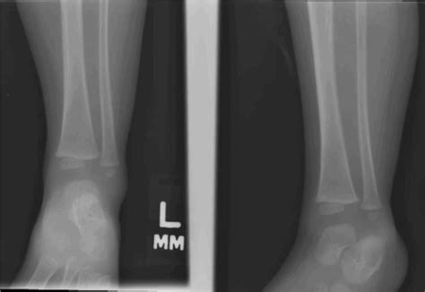 Spiral Fracture Tibia