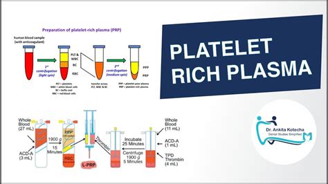 Platelet Rich Plasma Prp In Periodontics Biologic Properties Preparation Applications