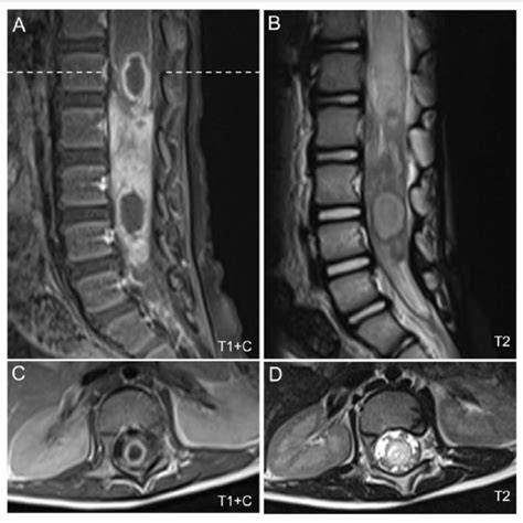 Lipomyelocele Sagittal A And Axial B Ultrasound Images Show An