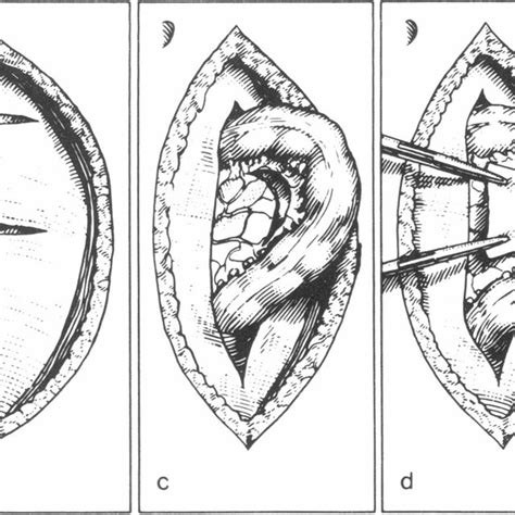 PDF Lahaut S Operation For Rectal Prolapse