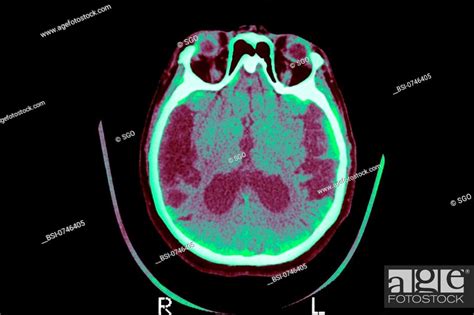 Alzheimers Disease Scan Axial Cut Away View Median Portion Of