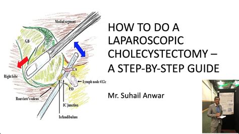 How To Do A Laparoscopic Cholecystectomy A Step By Step Guide Mr