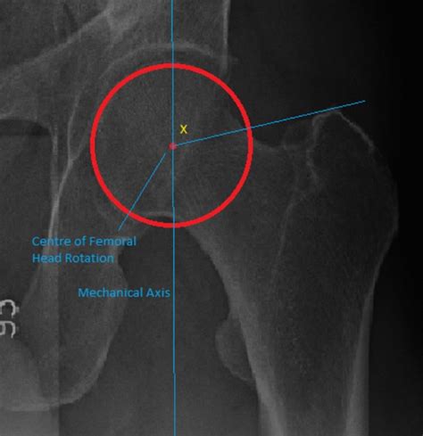 The Mechanical Greater Trochanter Angle Mgta Is The Angle Created