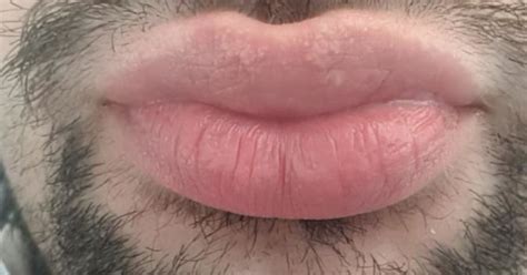 Does Anyone Know What These White Dots Are On My Lips Please Help