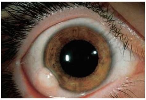 Conjunctival And Epibulk Choristomas Ento Key