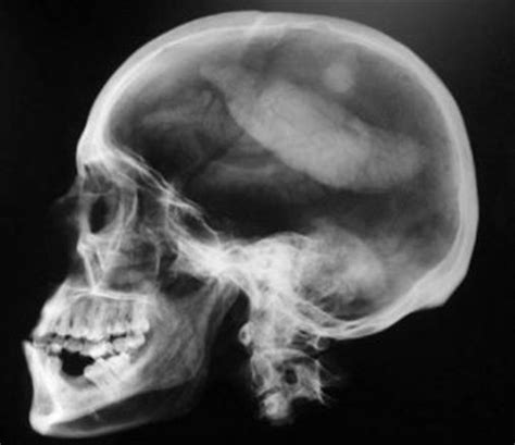 Radiografia Panorâmica Facial Pode Revelar Calcificação Na Base Do Crânio Editora Plena