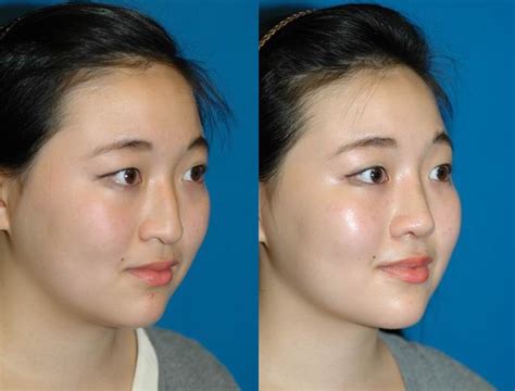 Asian Nose Job Before And After
