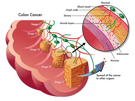 What Stage Of Colon Cancer Symptoms What Are The Four Stages Of