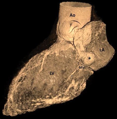 Anterior Mitral Leaflet Aneurysm Radiology