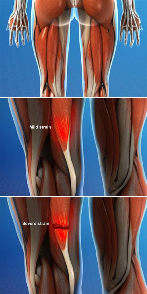 Muscle Strain Injuries Of The Thigh Dr Mark Tuttle