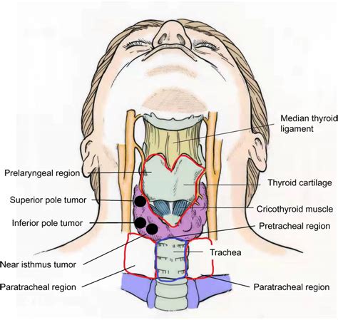 The Extent Of Therapeutic Central Compartment Neck Dissection In Unila