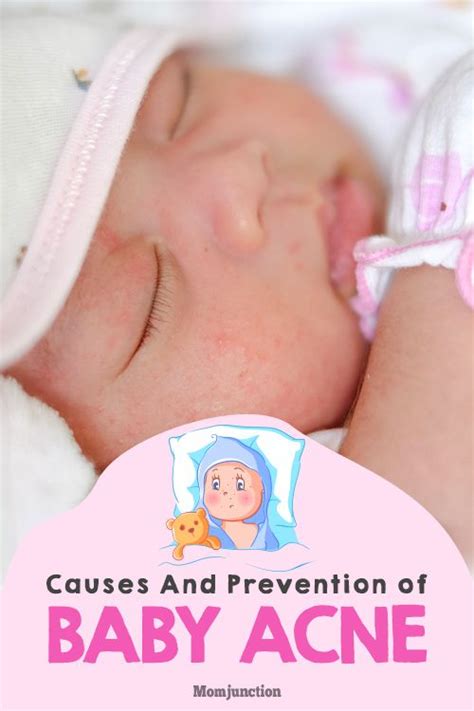 Baby Acne What Causes Them And How You Can Prevent Baby Acne