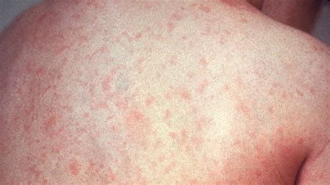 Five Things To Know About German Measles Ctv News