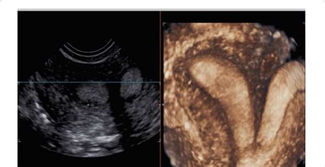 D Reconstruction Of Bicorporeal Uterus U Eshre Congenital Uterine