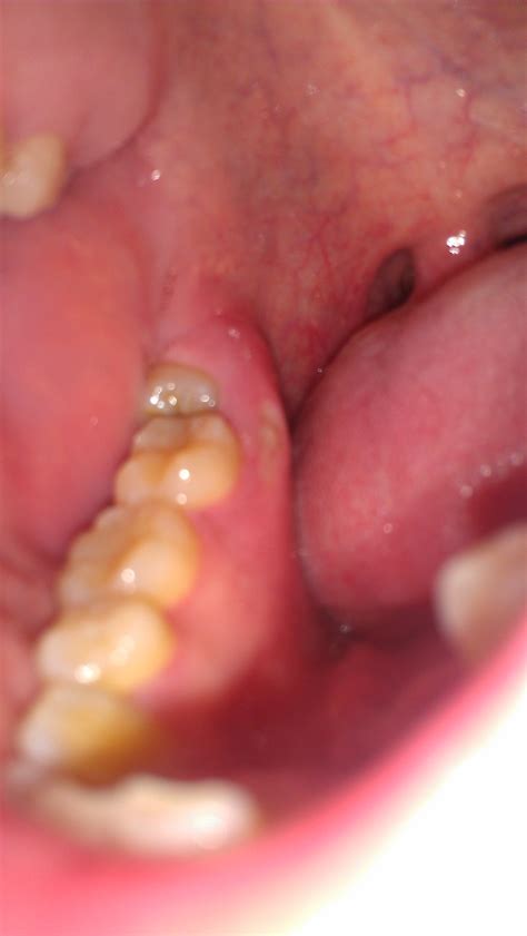 White Patch On Gum After Tooth Extraction