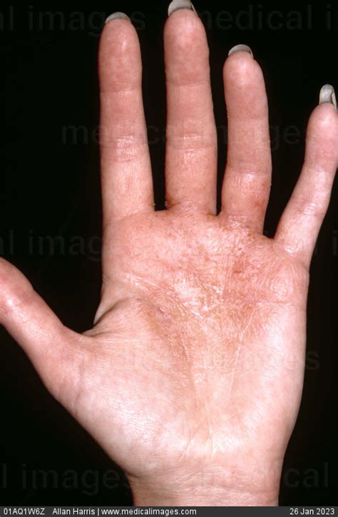 Stock Image Dermatology Palmar Contact Eczema A Very Dry Cracked And