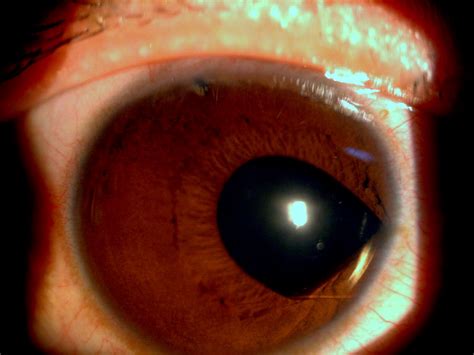 Implantable Collamer Lens Dislocation Ophthalmology